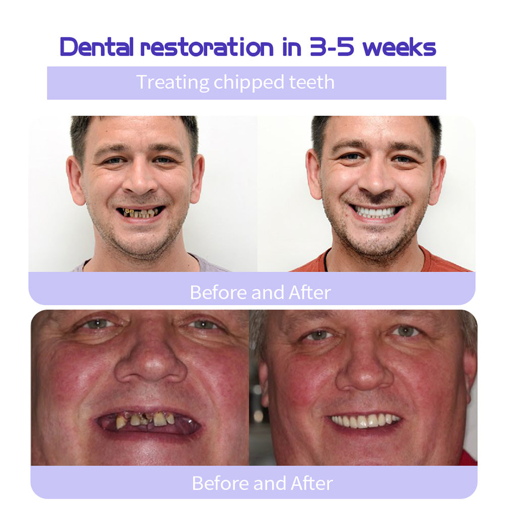 ODALIT™ Teeth Restoration Mineral Powder🦷(ADA recommended) (🎁Flash Sale - Don’t Miss Out)