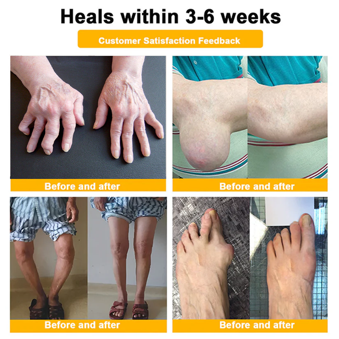 ODALIT™ Pain-Relief & Bone Healing Cream — Clinically Proven with Bee Venom & Botulinum Toxin