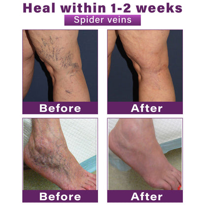 Seurico™ Polidocanol Nano Varicose Vein Patch Recommended by the Society for Vascular Surgery