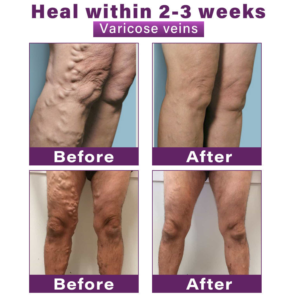 Seurico™ Polidocanol Nano Varicose Vein Patch Recommended by the Society for Vascular Surgery