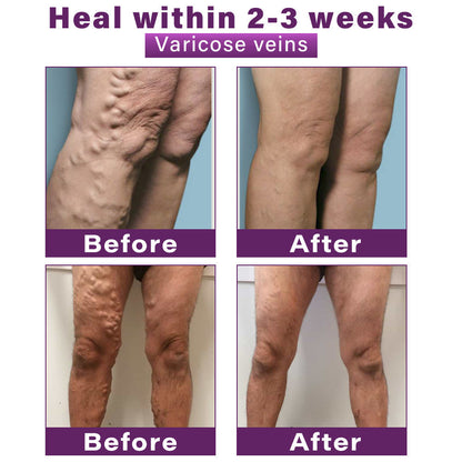 Seurico™ Polidocanol Nano Varicose Vein Patch Recommended by the Society for Vascular Surgery