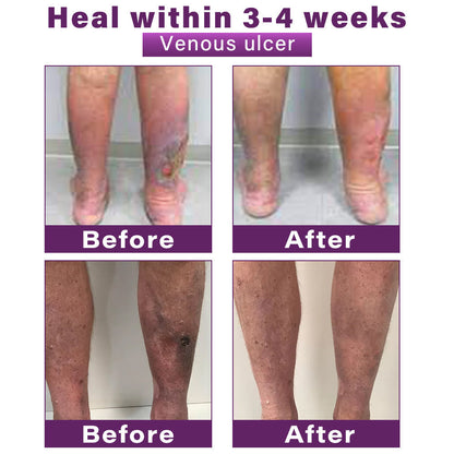 Seurico™ Polidocanol Nano Varicose Vein Patch Recommended by the Society for Vascular Surgery