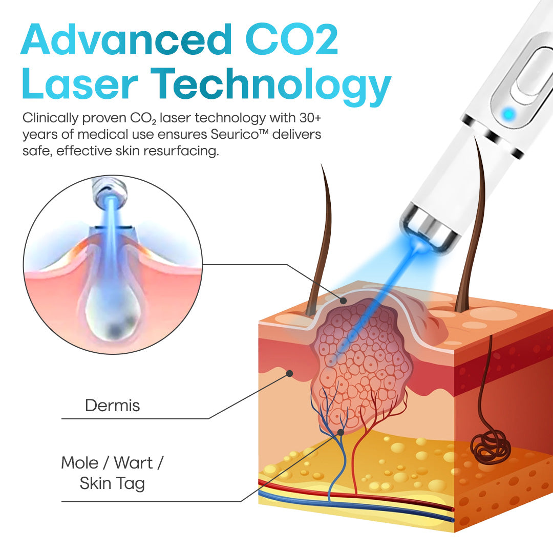 Seurico™ Laser Pen – Non-Invasive Mole and Wart Removal 1–3 days Dermatologist‑Recommended