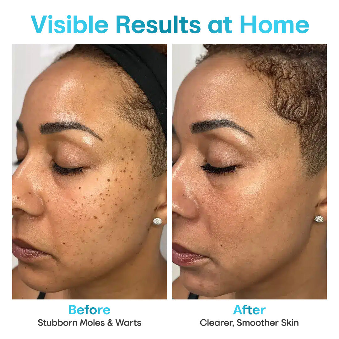 Seurico™ Laser Pen – Non-Invasive Mole and Wart Removal 1–3 days Dermatologist‑Recommended