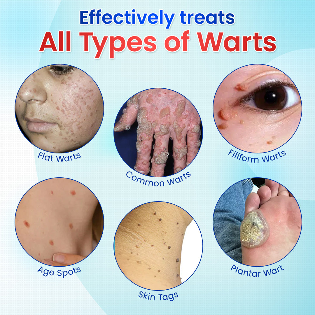 Odeiun™ Clearfrost Cryo Relief Spray🔥 – Advanced Wart & Skin Tag Removal Solution