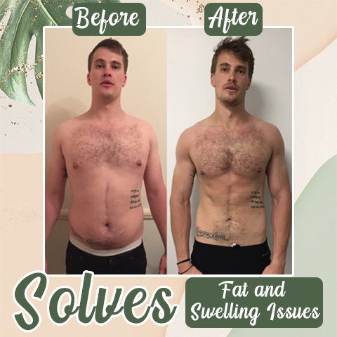 【Last Minute! 80% OFF】Seurico™ 𝗚𝗟𝗣 - 1 Microneedle Slimming Belt – Pure Natural Herbal Extract 🌿✨